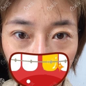 術前眼袋比較大 術前眼袋比較大