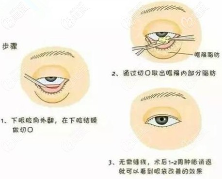 彭繼忠做微創(chuàng)祛眼袋手術 彭繼忠做微創(chuàng)祛眼袋手術