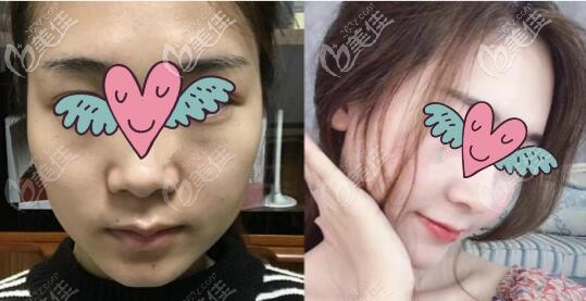 鉆石微雕面部吸脂術(shù)效果對(duì)比