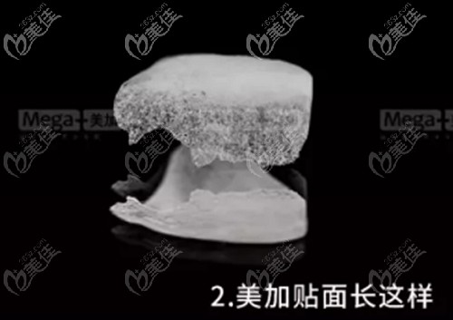 美加超薄牙貼面的外觀