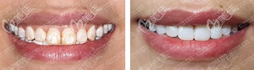 美加超薄牙貼面的前后效果對(duì)比
