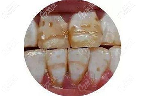 重度氟斑牙建議用美加貼面xs