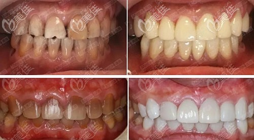 美加貼面XS案例展示