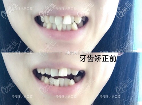 牙齒矯正前 牙齒矯正前