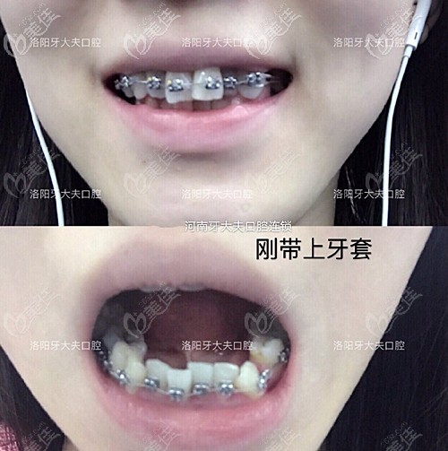 剛帶上牙套的效果 剛帶上牙套的效果