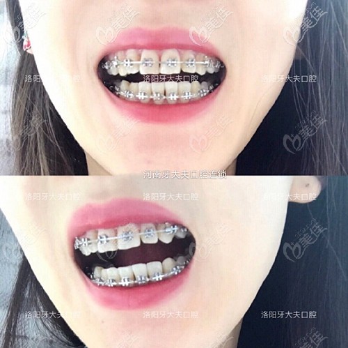 牙齒矯正半年效果 牙齒矯正半年效果