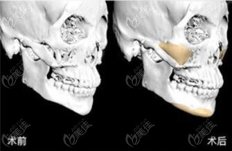 3D打印人工骨修復(fù)顴骨效果圖 3D打印人工骨修復(fù)顴骨效果圖