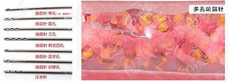 大腿吸脂采用的吸脂針 大腿吸脂采用的吸脂針