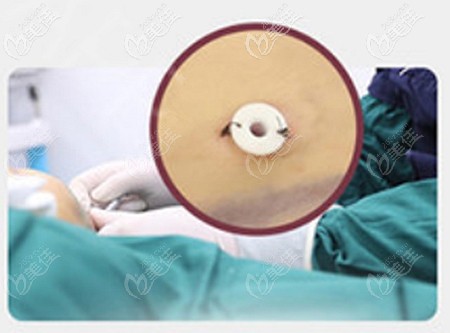 常州博仕做大腿吸脂的優(yōu)勢 常州博仕做大腿吸脂的優(yōu)勢