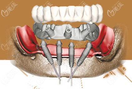 溫長(zhǎng)興醫(yī)生做韓系種植牙過程