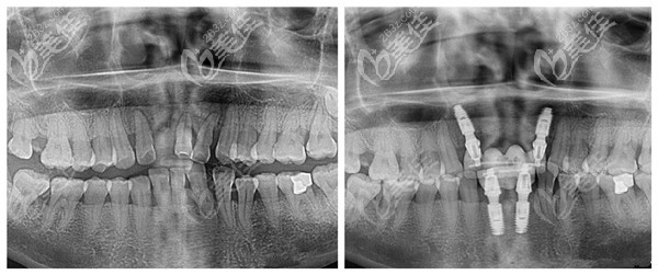 藍(lán)天口腔醫(yī)生溫長(zhǎng)興做種植牙實(shí)例