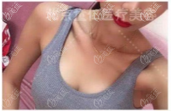 趙翊利傲諾拉閃耀毛面圓形假體隆胸案例