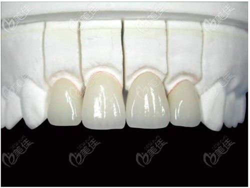 活髓牙做烤瓷牙使用壽命