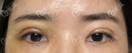 拆線后的眼睛 拆線后的眼睛