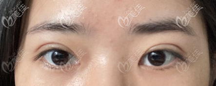 恢復(fù)一個月的眼部情況 恢復(fù)一個月的眼部情況