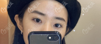 割6.5毫米雙眼皮消腫后窄了1毫米但并沒有變成內(nèi)雙