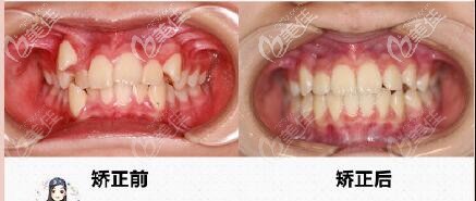 武漢亞韓隱適美矯正牙齒案例效果對(duì)比圖