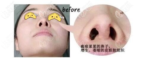 隆鼻失敗出現(xiàn)攣縮的鼻子