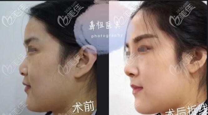 王剛醫(yī)生攣縮鼻修復(fù)前后對(duì)比案例