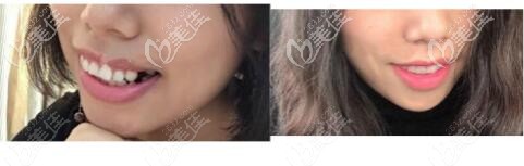 武漢齙牙加深覆合做隱適美隱形矯正案例效果