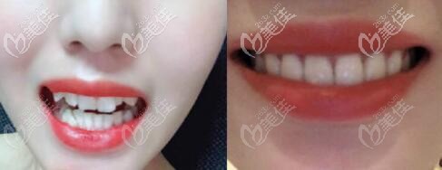 亞韓口腔深覆合+虎牙高位矯正案例效果