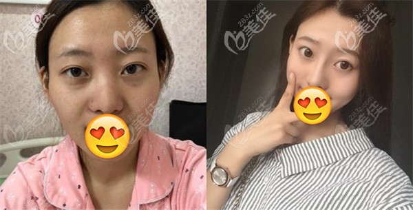 找沈院長做全肋軟骨隆鼻術前術后效果