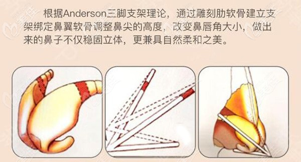 沈正宇醫(yī)生做隆鼻的手術原理