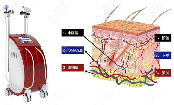 熱拉提治療圖示