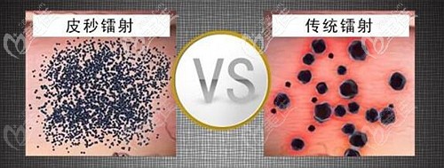 755蜂巢皮秒激光祛斑的優(yōu)勢 755蜂巢皮秒激光祛斑的優(yōu)勢