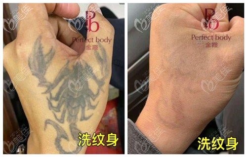 蜂巢皮秒洗紋身的效果前后對比 蜂巢皮秒洗紋身的效果前后對比
