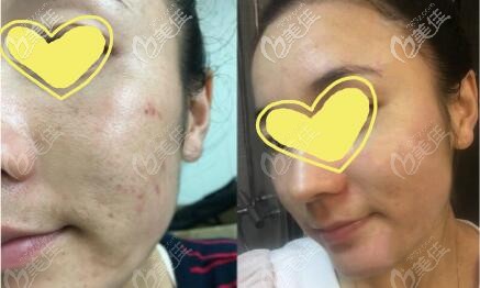 脈沖光法痘印真實(shí)治療效果圖