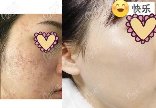 強(qiáng)脈沖光祛痘印真實(shí)治療效果對(duì)比圖