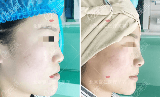 鼻基底抬高術(shù)前后即刻對比效果圖