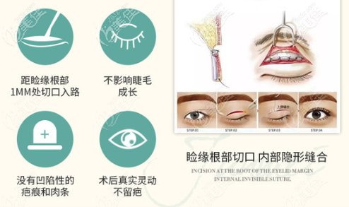 朱建瑩醫(yī)生做眼部整形手術(shù)的優(yōu)勢 朱建瑩醫(yī)生做眼部整形手術(shù)的優(yōu)勢