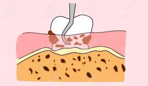 齦下刮治的原理 齦下刮治的原理