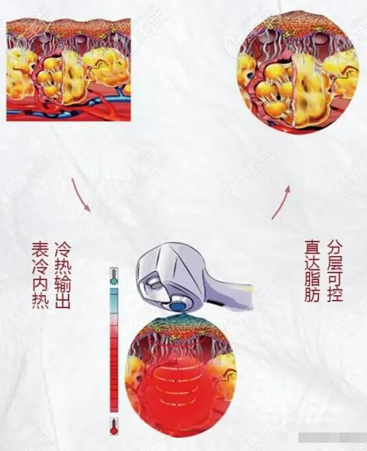 BTL脂肪刀的原理是利用超聲+單極射頻技術(shù)