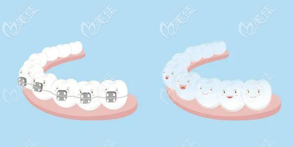 金屬托槽和隱形牙套都建議做全口矯正