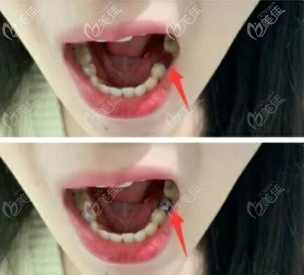 美國百康種植牙案例效果 美國百康種植牙案例效果