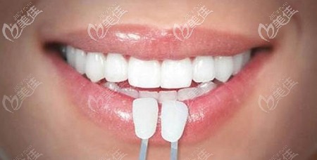 全瓷牙貼面效果 全瓷牙貼面效果