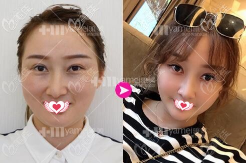 在長沙雅美做熱瑪吉術(shù)前術(shù)后效果對比 在長沙雅美做熱瑪吉術(shù)前術(shù)后效果對比