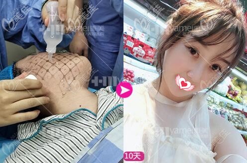 熱瑪吉治療過程與術(shù)后10天效果照 熱瑪吉治療過程與術(shù)后10天效果照