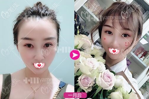 做熱瑪吉全臉1個(gè)月時(shí)的效果照 做熱瑪吉全臉1個(gè)月時(shí)的效果照