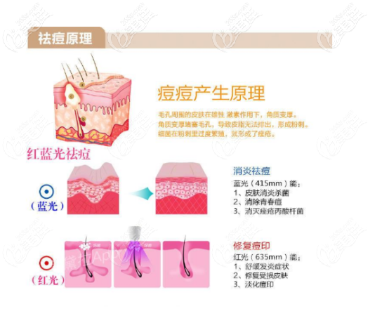 紅藍光治療痘痘的原理 紅藍光治療痘痘的原理