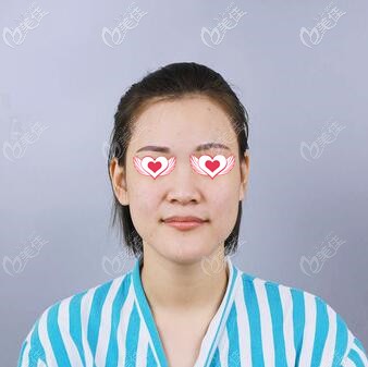 做假體隆鼻術(shù)前照 做假體隆鼻術(shù)前照