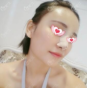 假體隆鼻+脂肪豐太陽穴第3天 假體隆鼻+脂肪豐太陽穴第3天