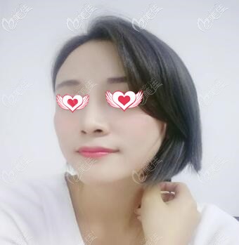 假體隆鼻術(shù)后1周拆線 假體隆鼻術(shù)后1周拆線