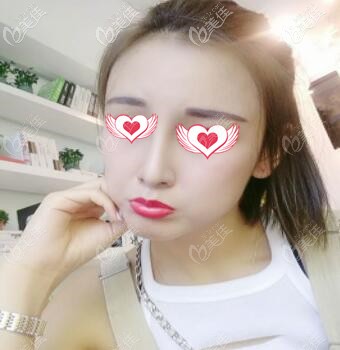 假體隆鼻脂肪填充太陽穴術(shù)后1個(gè)月效果照 假體隆鼻脂肪填充太陽穴術(shù)后1個(gè)月效果照