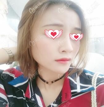 這是我在海南華美做的硅膠假體青春小翹鼻66天效果，鼻子確實(shí)變得挺翹立體了！