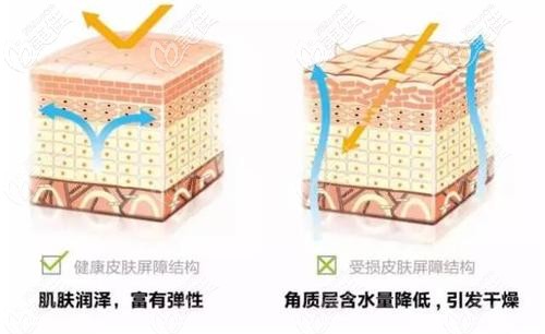 舒敏之星修復(fù)角質(zhì)層的原理