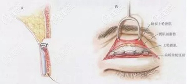park法的縫合方式